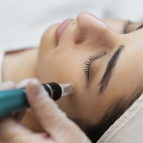 visage de femmes recevant un soin Microneedling.